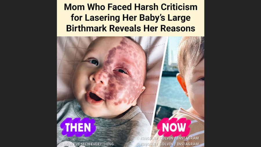 Mother branded a ‘monster’ over using controversial laser treatment on her baby son’s birthmark shares health update as he hits major milestone